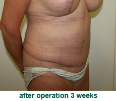 plastic-surgery-tummy-tuck